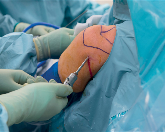 knee-arthroscopy