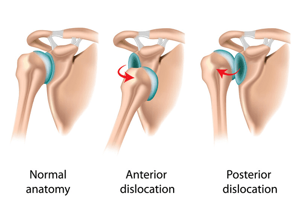 shoulder-dislocation